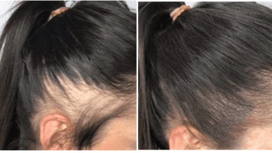 स्कैल्प माइक्रोपिग्मेंटेशन क्या है? - What is scalp micropigmentation?